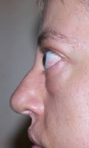 The most common cause for unilateral or bilateral exophthalmos is thyroid eye disease , or graves ophthalmopathy. Exophthalmus