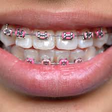 Maybe you would like to learn more about one of these? Fake Braces For Sale Dental News Network