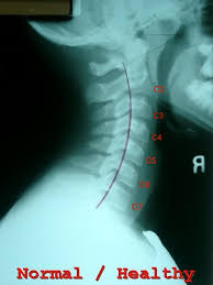 This procedure may be used to diagnose back or neck pain, fractures or broken bones, arthritis, degeneration of the disks, tumors, or other problems. X Rays Of My Spine And Explanation Of Why I M Doing This Fit At 50 The Recovery
