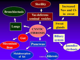 Bronchiectasis