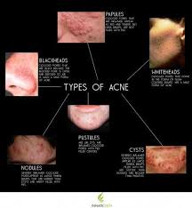Acne Types How To Recognize What Kind Of Acne You Have Types Of Acne Skin Treatments Acne
