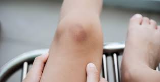 How To Get Rid Of Bruises: 10 Natural Remedies - Dr. Axe