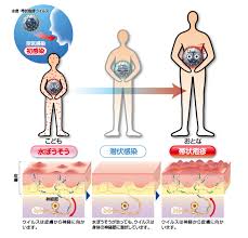 ＃健康に関する動画一覧はこちら ＃帯状疱疹 ＃薬予防 薬をつかわないで帯状疱疹を早くなおすための有効な方法 ＝＝＝＝＝☆関連動画☆＝＝＝＝ 注意!!間違った帯状疱疹の治療方法 ヒカル（hikaru）さんの動画↓ 【大食い】ウイルス性の感染症. å¸¯ç¶ç±ç¹ã£ã¦ å¸¯ç¶ç±ç¹ ãã«ãæ ªå¼ä¼ç¤¾