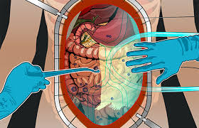 Antes da cirurgia citorredutora com ressecção do peritônio parietal (membrana que recobre a parede abdominal) e o uso da quimioterapia intraperitoneal . Hipec Anos De Vida Em Vez De Meses Com Tumores Malignos Da Cavidade Abdominal