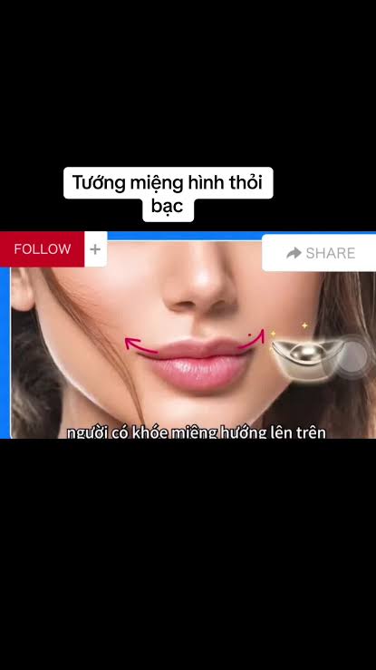 Thẩm mỹ tạo khóe miệng cười an toàn