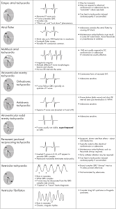 What does svt stand for? Mechanisms Of Tachycardia Av Atrioventricular Iv Intravenous Svt Download Scientific Diagram