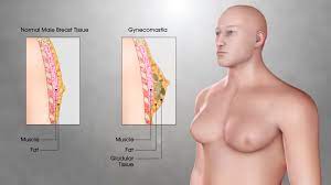 Among the cancers seen in the male breast are: Gynecomastia Gynaecomastia Symptoms Causes And Treatment Scientific Animations