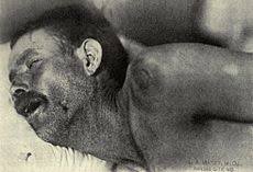 See meningitis (peds) for the pediatric page. Ø§Ù„ØªÙ‡Ø§Ø¨ Ø§Ù„Ø³Ø­Ø§ÙŠØ§ ÙˆÙŠÙƒÙŠØ¨ÙŠØ¯ÙŠØ§