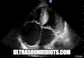 Image result for Restrictive Cardiomyopathy