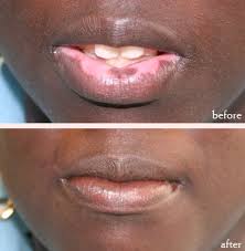 Image result for Postinflammatory Hypopigmentation