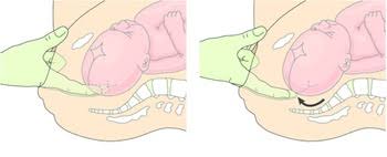 Image result for Vacuum Caput