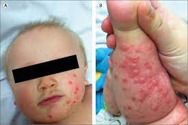 What are the signs and symptoms of hand, foot, and mouth disease (hfm)? Atypical Hand Foot And Mouth Disease A Vesiculobullous Eruption Caused By Coxsackie Virus A6 The Lancet Infectious Diseases