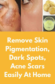 Pin On Home Remedies 4 Acne