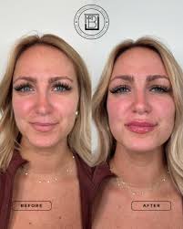 🎉💉GIVEAWAY!!💉🎉 In honor of #nationalbotoxday