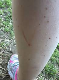 The bites usually aren't fatal, but they can still cause some serious and uncomfortable. Mum S Horror As Huge Blisters Grow On Leg After False Widow Spider Bite Grimsby Live