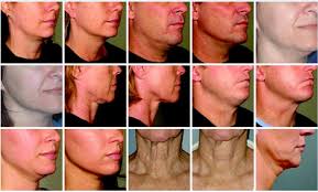 Check spelling or type a new query. Natural Ways To Get Rid Of Turkey Neck Natural Beauty Cream