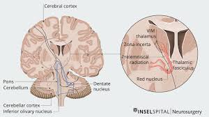 Image result for Essential Tremor