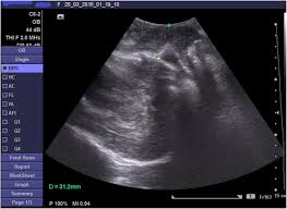 Jika sekolah atau siswa belum mengetahui nisn atau. Transperineal Ultrasound Of Fetal Head Progression In Prolonged Labor Women S Acceptance And Ability To Predict The Mode Of Delivery Egyptian Journal Of Radiology And Nuclear Medicine Full Text