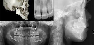 Check spelling or type a new query. Control Of The Occlusal Plane In Orthognathic Surgery Ajo Do Clinical Companion
