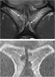 Image result for Pubic Apophysitis