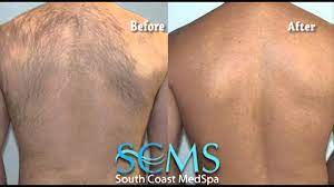‍ painless back hair removal. Male Laser Hair Removal On Back Before After Youtube