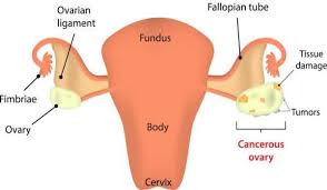 About 90 percent of ovarian when they are caused by ovarian cancer, they tend to be persistent and a change from normal − for example, they occur more often or are more severe. Ovarian Cancer Health Tips Ovarian Cancer Health Articles Health News Thehealthsite Com