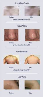 This will allow ample recovery time. Laser Hair Removal And Skin Treatment Riverview Health