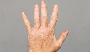 Image result for Vitiligo