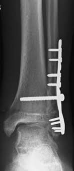 Nine patients sustained a maisonneuve fracture of the fibula (mff), which is a proximal fibula fracture associated with an ankle fracture or deltoid ligament tear. Ankle Fractures Trauma Orthobullets