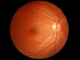 Another adhd drug called cylert (pemoline) can cause: Case Intermittent Headaches And Blurred Vision