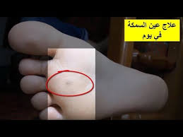 طريقة علاج عين السمكة في يوم واحد مع الحذر من استخدام المواد المطلوبة Youtube