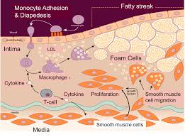 Pathogenesis Of Atherosclerosis