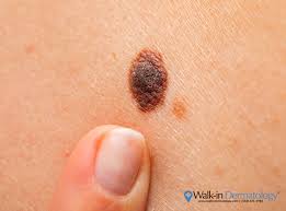 Spot that looks like a new mole, freckle, or age … What Happens If You Accidentally Scratch Off A Mole Walk In Dermatology
