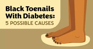 Image result for toe black diabetes
