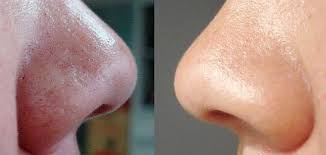 Cara nak hilangkan jerawat dan jeragat. 6 Petua Hilangkan Blackhead Whitehead Dengan Bahan Semula Jadi Nurraysa