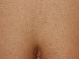 (pubic hairs for women and tanlines). Eruptive Vellus Hair Cysts Dermnet Nz