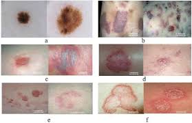The most common skin cancer pictures and photos the three most common forms of skin cancer are malignant melanoma, squamous cell carcinoma and basal cell carcinoma. Skin Diseases Images A Isic 2019 Skin Cancer B Acnes C Eczema D Download Scientific Diagram