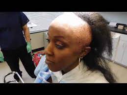 Ccca Alopecia Scarring Alopecia Friendly Black Hair Styles Sydneynicolehair Com Skyler Hairstyl Black Women Hair Loss Hair Loss Women Alopecia Hairstyles