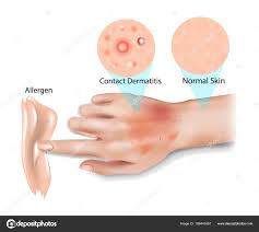 Image result for dermatitis contacta