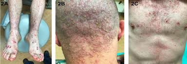 This common viral illness primarily affects infants and children under the age of 5. Atypical Presentation Of Hand Foot And Mouth Disease In An Adult The Western Journal Of Emergency Medicine