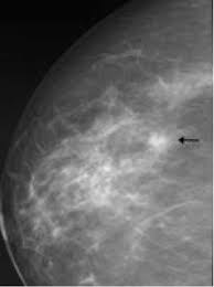Carcinoma duttale in situ di grado intermedio con necrosi e microcalcificazioni. Ecografia Mammaria Senologiadiagnostica