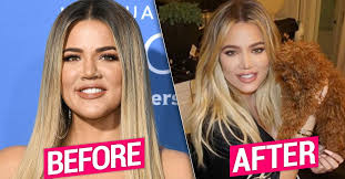 According to khloe kardashian, one nose job is the extent of her surgery. Khloe Kardashian Nose Job