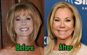 She managed to rein in her aging signs and traded them for a youthful . Kathie Lee Gifford Plastic Surgery Facelift Neck Lift Before After Celebritysurgeryicon