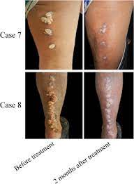 Recently, intralesional immunotherapy by different antigens has been associated with. Successful Clearance Of Extensive Recalcitrant Cutaneous Warts By Acitretin Monotherapy A Case Series Study Zhang 2020 Dermatologic Therapy Wiley Online Library