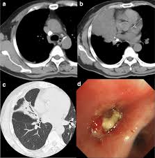 Image result for Broncholithiasis
