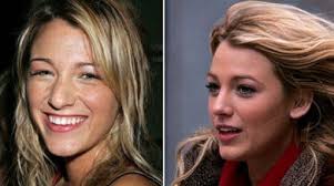 Weblyest Top 19 Celebrities Before And After Plastic Surgery Blake Lively Nose Blake Lively Plastic Surgery Celebrity Plastic Surgery