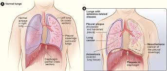 Mesothelioma, also known as malignant mesothelioma, is cancer of that tissue. Find Out About Symptoms Diagnosis And Treatments For Mesothelioma Action On Asbestos Industrial Injury Disease