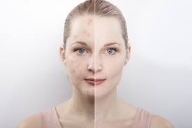 Check spelling or type a new query. Hormonal Acne Natural Treatment Along With Causes Symptoms And Diet Plan Love Gift For Her Or Him Gift Idea