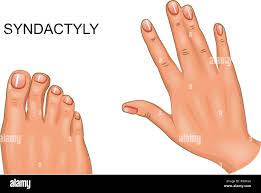 Image result for Syndactyly
