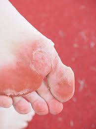 Kaposi sarcoma (ks) usually appears first as spots (called lesions) on the skin.the lesions can be purple, red, or brown. Is It A Diabetic Foot Sore Learn The Early Signs Reid Health